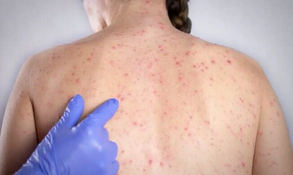 Casos de sarampo sobem para 16 em São Paulo